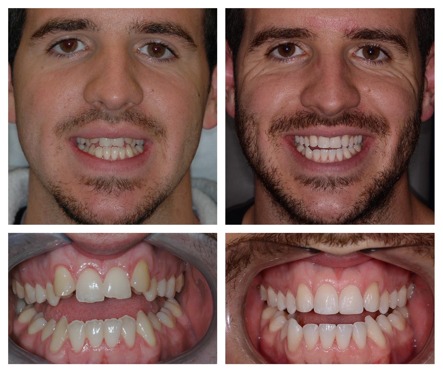 invisible braces before and after